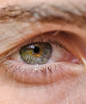 droopy eyelid